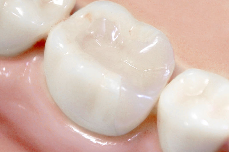 セラミック治療の特徴と費用