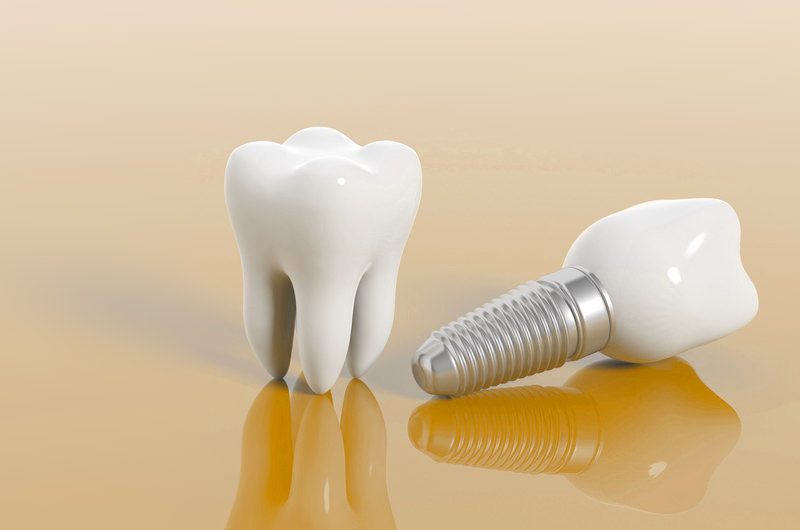 インプラントとは