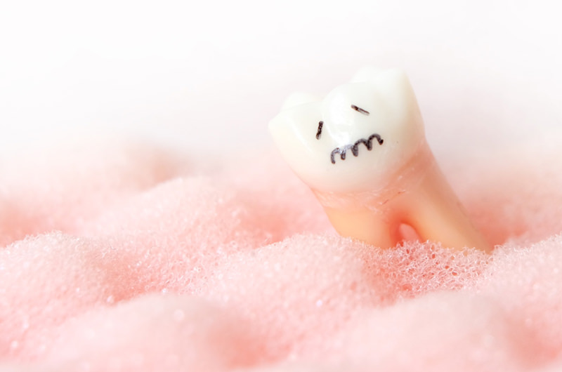 むし歯治療とは