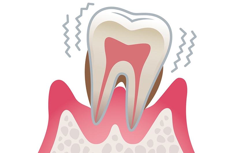 重度歯周病の症状と治療法